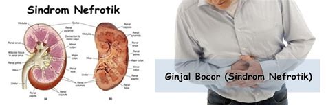 6 Ciri Ciri Penyakit Ginjal Bocor Pada Orang Dewasa Spesialis Ginjal