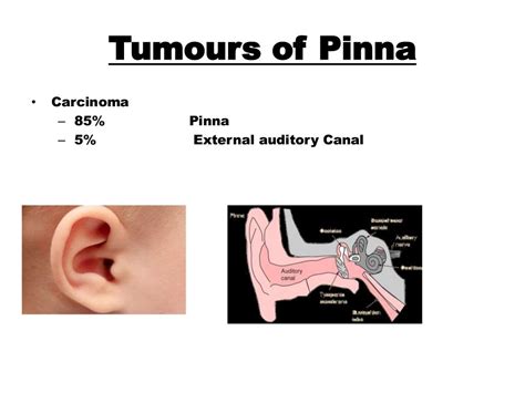 Tumours Of Ear