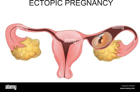 Ectopic Pregnancy Hi Res Stock Photography And Images Alamy