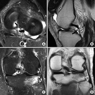 A Axial Fat Suppressed T Weighted Mr Image And B Sagittal Turbo