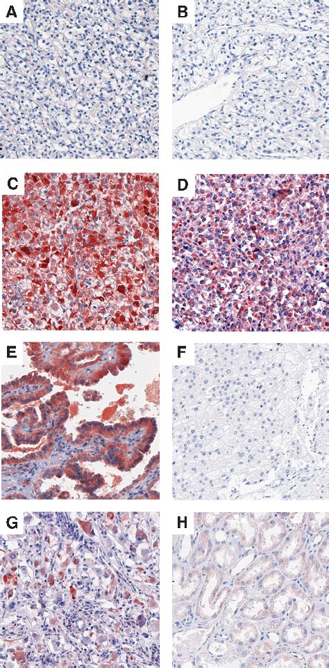 Immunohistochemical Detection Of Dcr3 Protein In Rccs Of Diverse