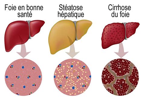 Stéatose Hépatique Quest Ce Que Cest La Maladie Du Foie Gras Bmoove