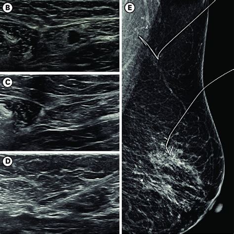 A 72 Year Old Woman With Left Breast Cancer And Ipsilateral Axillary Download Scientific