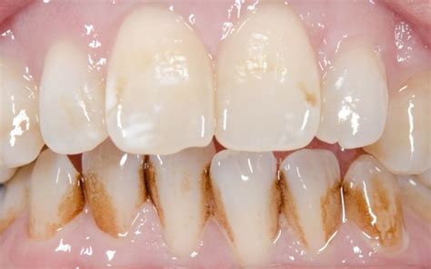 Types Of Teeth Stains: Causes & Treatment At Bassendean