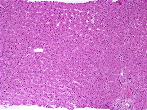 Pathology Outlines - Benign recurrent intrahepatic cholestasis