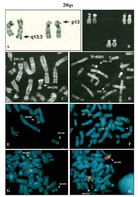 20qs: (A) reciprocal translocation involving a chromosomes 20 and a ...