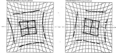 hess screen result  case  shows bilateral overaction