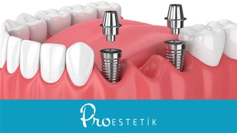 German Dental İmplant Brands Top 5 Implant Brands Proestetik