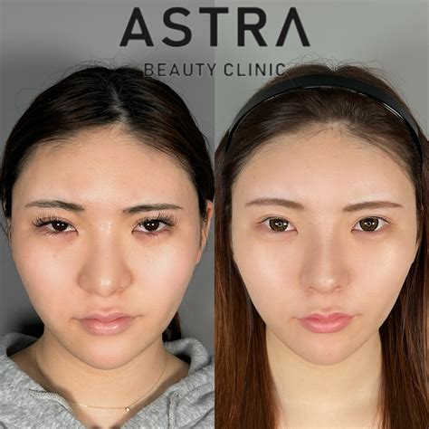 プロテーゼ・鼻尖形成・軟骨移植・他院修正・脂肪注入（額） 【公式】astra Beauty Clinic（アストラビューティクリニック