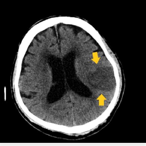 Ct Scan On The Second Day Of Admission Showing Large Evolving Infarct Download Scientific