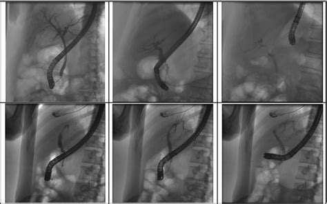 Cholangiogram Images Obtained During Endoscopic Retrograde Download Scientific Diagram