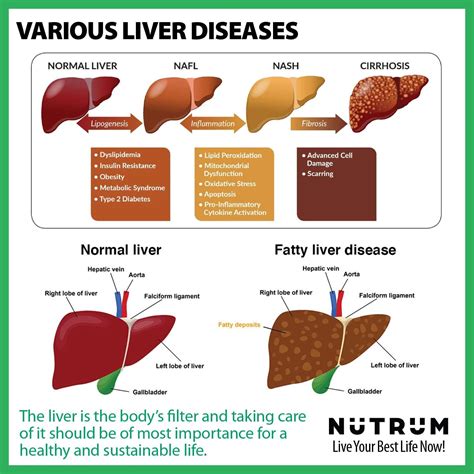 Nutrum Liver Cleanse And Detox Supplement Herbal Formula With Milk Thistle And Vitamin C For Liver