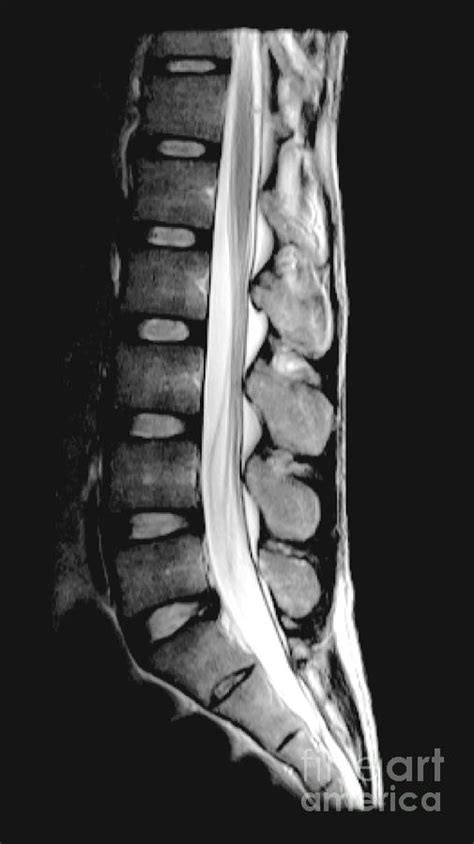 Lumbar Spine Mri Mri Scan Images Mri Mri Scan Lumbar Images