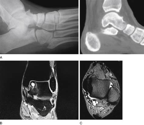 Anterior Ankle Impingement Clinical Tree