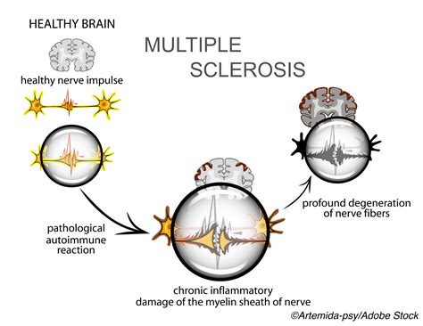 MS Disease-modifying Therapy Shows Reduced Disability Accrual Over 15 ...