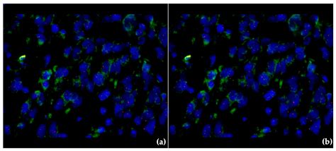 Multiple Primary Melanoma Associated With Cdkn A Mutationcase Report