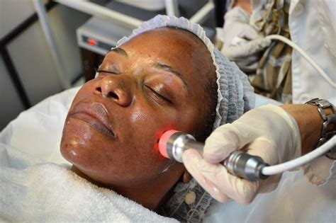 Radiofrequency Skin Tightening