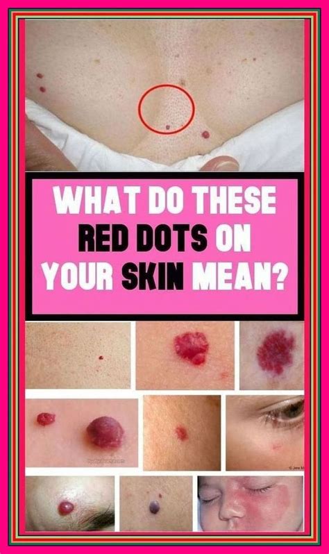 What Causes Red Moles On Skin And How To Get Rid Of Them Artofit