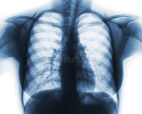 Film Chest X Ray Show Normal Chest Of Woman Stock Image Image Of