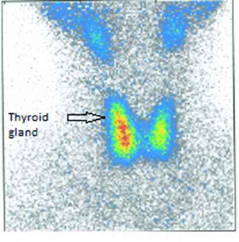 Thyroid Scintigraphy Acquired By A Static Mode 20 Min After Intravenous