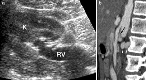 Nutcracker Syndrome In A Teenager With Asymptomatic Gross Hematuria Download Scientific