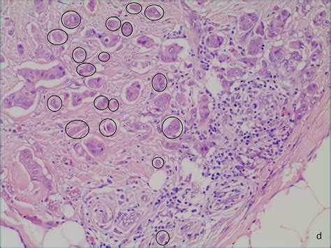 Scielo Brasil Tumor Budding In Invasive Breast Carcinoma