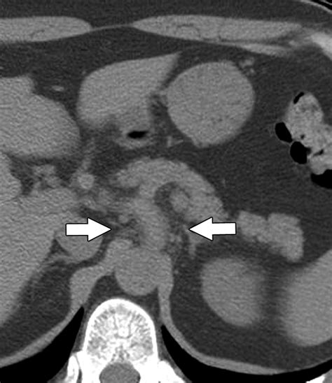 Spontaneous Isolated Dissection Of The Celiac Artery Ct Findings In