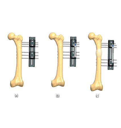 Femur Lengthening Treatments Orthofix ABS