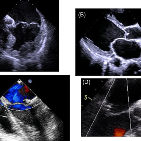 Transesophageal Echocardiography Preoperative A The Pl Is Download Scientific Diagram