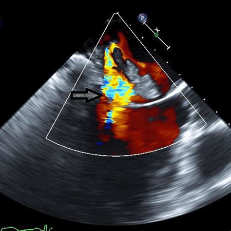 Three Dimensional Transesophageal Echocardiogram Doppler Image Showing