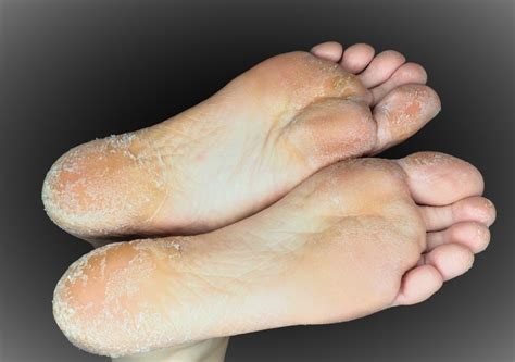 What Causes Peeling Skin On Feet