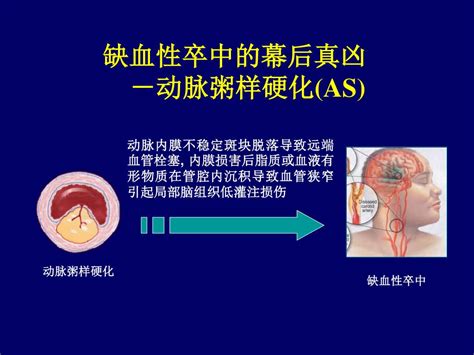 Ppt 短暂性脑缺血发作 Tia 研究进展 Powerpoint Presentation Id6960264