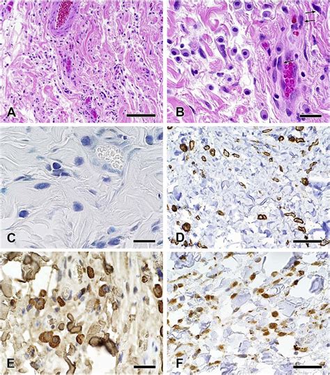 Histopathology of solitary mastocytoma of the eyelid. A. The dermis ...