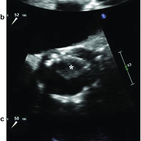 Transesophageal Echocardiography Mid Esophageal Long Axis View A