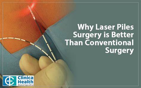 Why Laser Piles Surgery Is Better Than Conventional Surgery