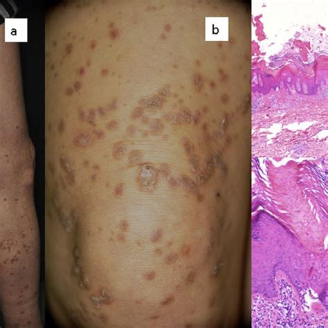 Clinical Appearance Annular Brown Hyperkeratotic 0 5 1 Cm In