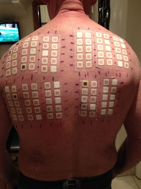 This is what an allergy test looks like : r/Damnthatsinteresting