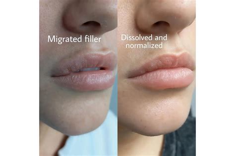 Lip Filler Migration Massage And How To Prevent Freaktofit