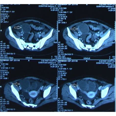 CT sections showing a hemorrhagic ovarian cyst. | Download Scientific Diagram