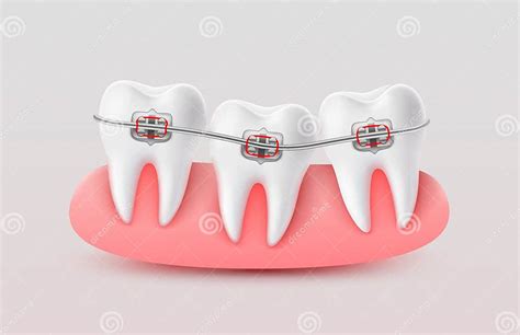 Installing Braces On Teeth Straightening Crooked Bites Vector