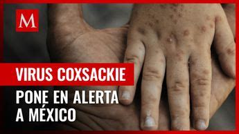 Virus coxsackie Qué es síntomas y cómo se contagia Grupo Milenio