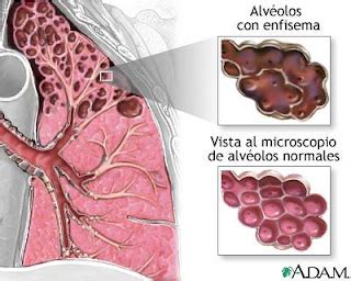 Fisio Na Patologia Enfisema Pulmonar