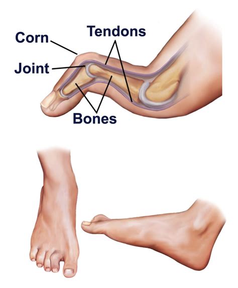 What Causes Hammertoe? | Canyon Oaks Foot & Ankle