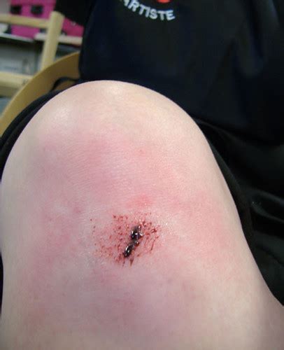 Grazed Knee Grazed Knee With Synwax And Blood Helen Quinn Flickr