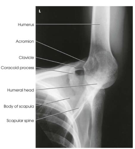 Shoulder, clavicle, and scapula X-rays Flashcards | Quizlet