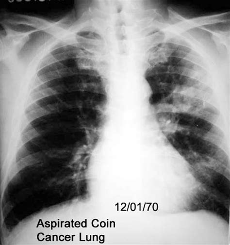 Pneumonia Chest X Ray Diagnosis