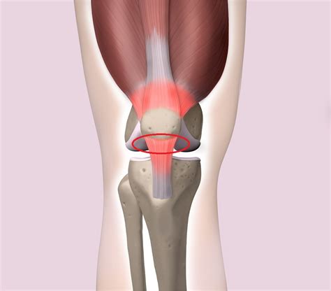 Tendinite Patelar Rotuliana joelho do saltador Clínica José Fontes