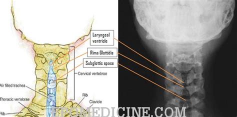 Neck Soft Tissue Radiograph Anatomy