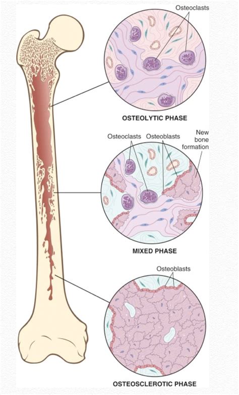 Paget S Disease On Bone Scan Nuc Med Clinics