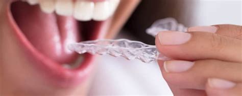 Invisalign Clear Braces Dentist Kent WA Seablue Dental